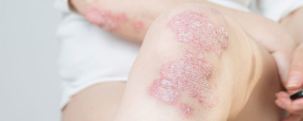 psoriasis
