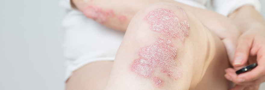 psoriasis